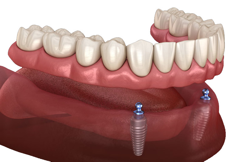Implant supported dentures example model